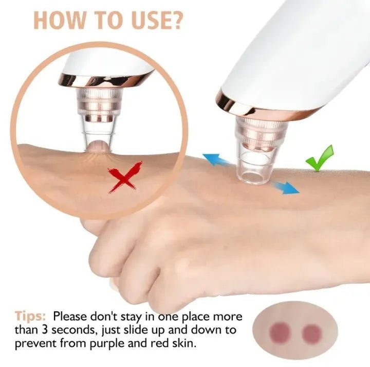 5 - in - 1 Blackhead Remover | Clear Skin in Seconds - Osolex