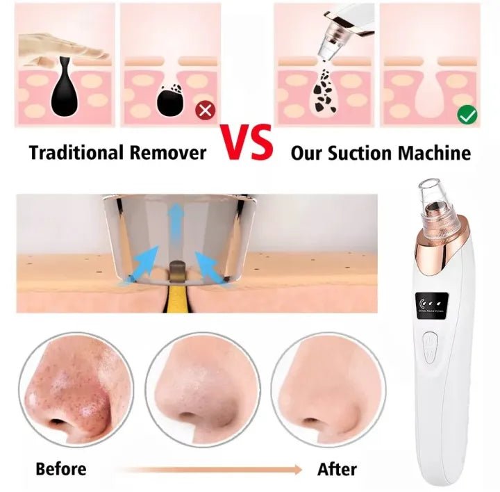5 - in - 1 Blackhead Remover | Clear Skin in Seconds - Osolex